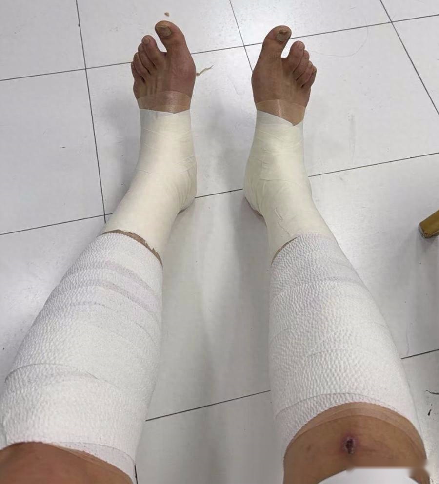  胜山西谁注意翟晓川赛后伤势？双腿拉伤绑满绷带，看着都残忍！